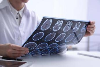 sin diagnosi piu rapide e farmaci innovativi cambiano decorso sclerosi multipla 2