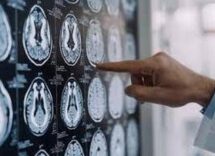 stop tremori parkinson senza bisturi 10 pazienti curati con ultrasuoni a napoli 2