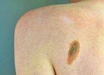 imi bene legge su prevenzione melanoma educare i giovani su rischi 2