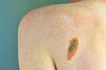 melanoma adoi bene nuova legge su prevenzione dermatologo centrale in screening 2