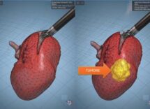 modelli tridimensionali biomimetici del cancro al rene di un paziente per chirurgia robotica sempre piu precisa 2