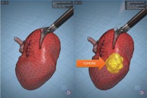 modelli tridimensionali biomimetici del cancro al rene di un paziente per chirurgia robotica sempre piu precisa 2
