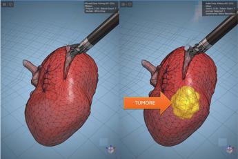 modelli tridimensionali biomimetici del cancro al rene di un paziente per chirurgia robotica sempre piu precisa 2