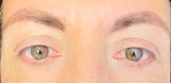 visione annebbiata o distorta spia di retinopatia ne soffre il 30 dei diabetici prevenzione larma piu efficace 2