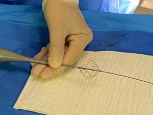 fibrillazione atriale aou marche prima volta in italia ablazione con catetere a campo pulsato 2