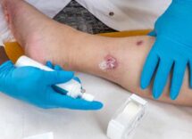 idrosadenite suppurativa le iniziative di ucb per migliorare diagnosi e cura 2