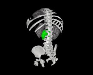 chirurgia su misura al bambino gesu di roma rimosso complesso neuroblastoma a bimba di 1 anno 2