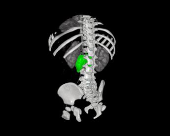chirurgia su misura al bambino gesu di roma rimosso complesso neuroblastoma a bimba di 1 anno 2