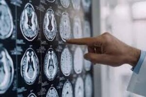 malattia di parkinson ok in europa a formulazione orale ld cd a rilascio modificato 2