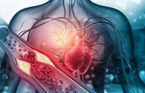 arterosclerosi studio nuova molecola riduce di piu il colesterolo cattivo 2