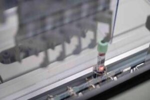 cancro del pancreas allo studio test del sangue per la diagnosi precoce 2