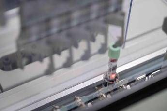 cancro del pancreas allo studio test del sangue per la diagnosi precoce 2