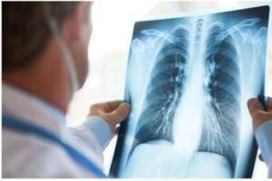 cancro polmone egfr mutato studio fase 3 adaura il 79 dei pazienti vivo a 8 anni con osimertinib 2
