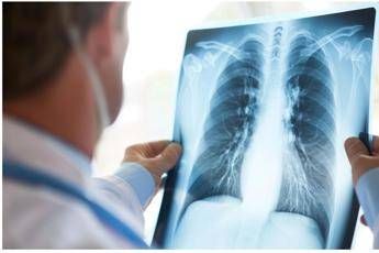 cancro polmone egfr mutato studio fase 3 adaura il 79 dei pazienti vivo a 8 anni con osimertinib 2