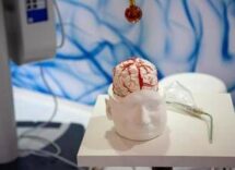 dai gliomi al parkinson cosi lintelligenza artificiale aiuta la neurochirurgia 2