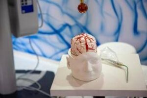 dai gliomi al parkinson cosi lintelligenza artificiale aiuta la neurochirurgia 2