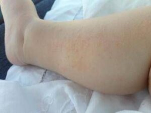 dermatite atopica aifa estende rimborso di upadacitinib dai 12 anni di eta 2