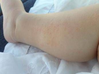 dermatite atopica aifa estende rimborso di upadacitinib dai 12 anni di eta 2