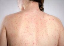 morbillo e allarme negli usa italia prima per casi in europa in in primi 6 mesi 2026 2