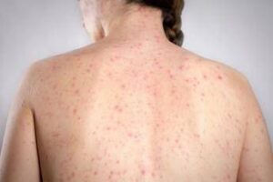 morbillo e allarme negli usa italia prima per casi in europa in in primi 6 mesi 2026 2