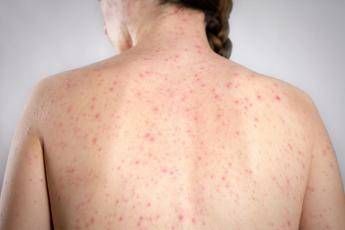 morbillo e allarme negli usa italia prima per casi in europa in in primi 6 mesi 2026 2