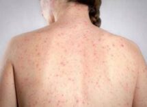 morbillo lallarme dellinfettivologo andreoni casi in crescita ricoveri frequenti negli adulti 2