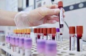 sclerosi multipla recidivante ema raccomanda approvazione ocrelizumab dai 10 anni 2