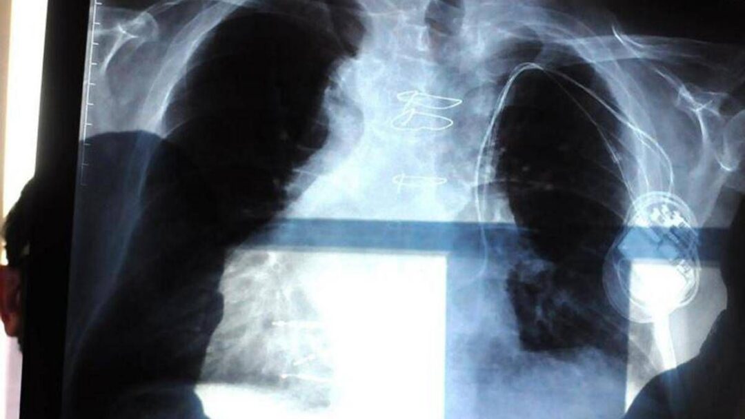 cancro al polmone aggressivo combinazione farmaci riduce del 58 rischio morte 2