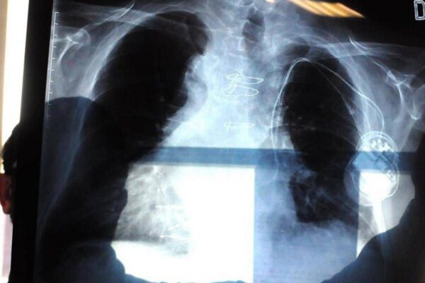 Cancro al polmone aggressivo, combinazione farmaci riduce del 58% rischio morte