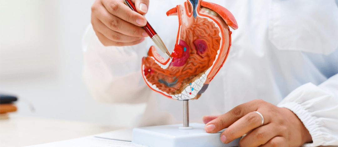 Cancro allo stomaco avanzato, nuova terapia riduce del 42% il rischio di morte ﻿