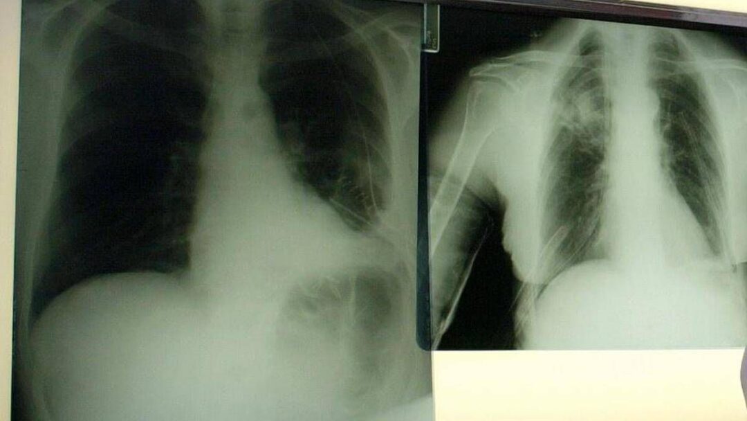 cancro polmone con nuova combinazione malattia sotto controllo piu a lungo 2