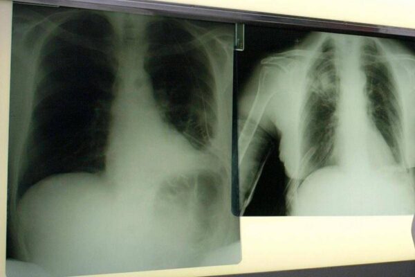 Cancro polmone, con nuova combinazione malattia sotto controllo più a lungo