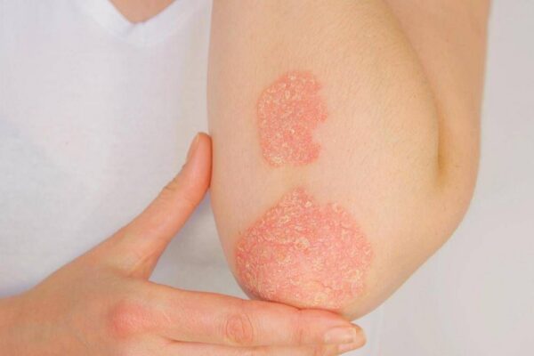 Giornata psoriasi, Ucb rinnova l’impegno contro lo stigma