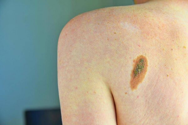 Melanoma, la firma mutazionale del cancro potrà cambiare la cura﻿