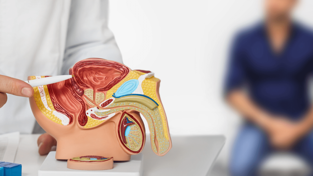 tumore prostata ad alto rischio recidiva nuova terapia riduce del 58 rischio morte o metastasi 2