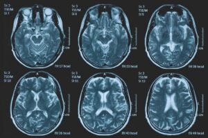 una persona su 3 ha un disturbo neurologico a napoli arriva brainspace house 2
