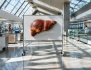 MASLD: fino al 70% dei pazienti con diabete colpisce il fegato